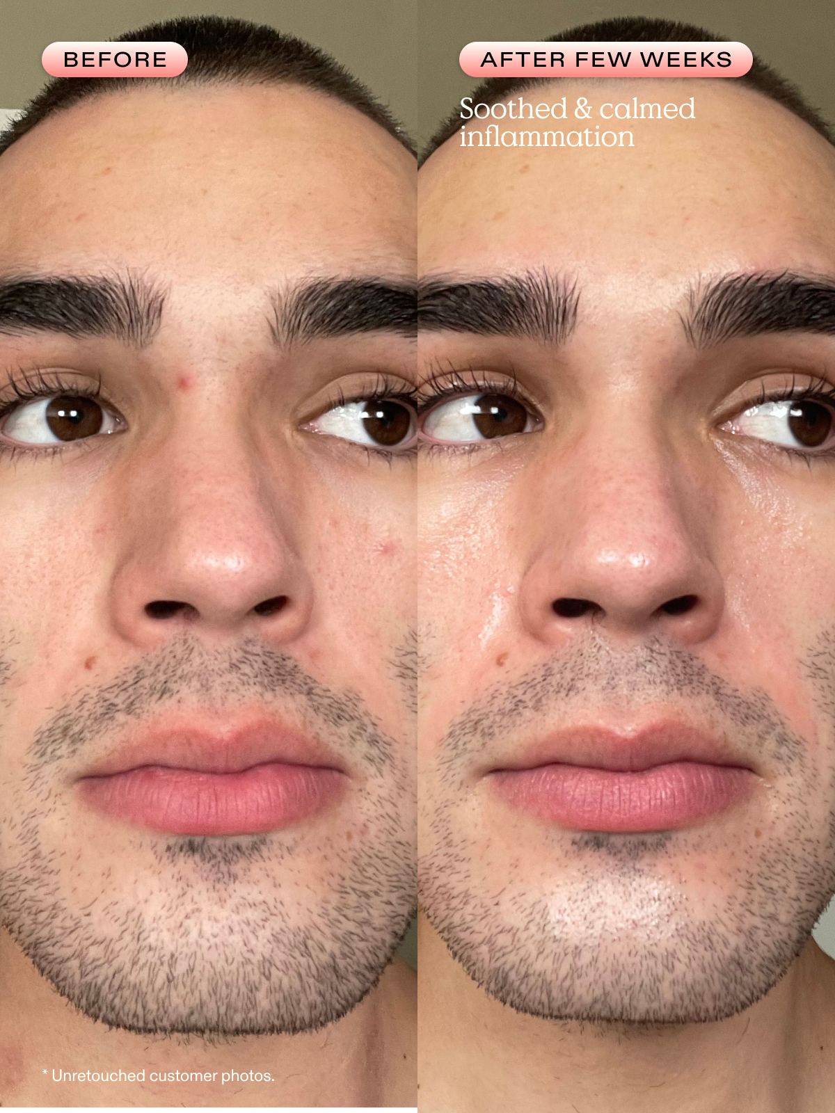 Before and after a few weeks of using Oil La La. Inflammation is soothed and calmed.