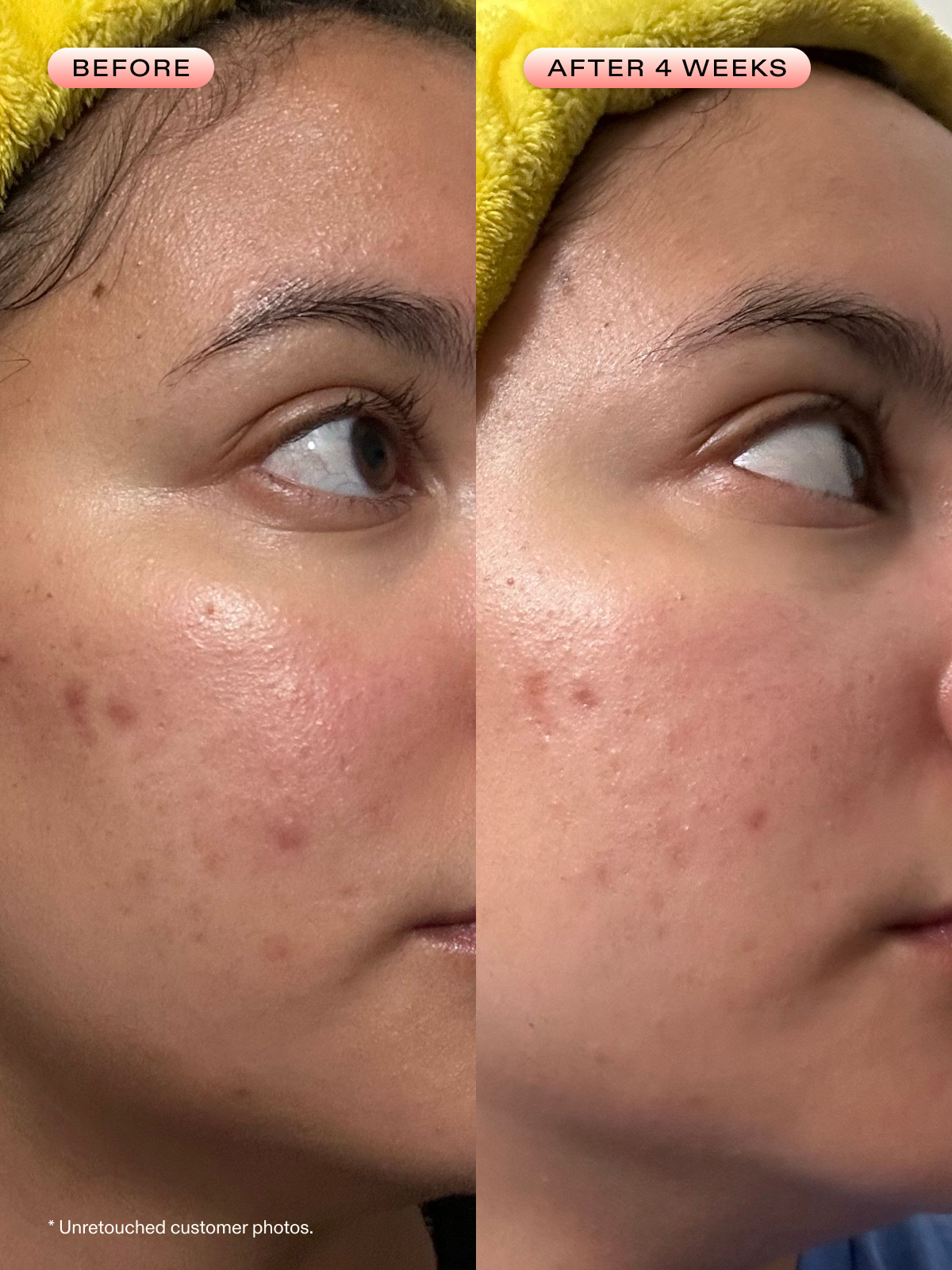 Before and after 4 weeks of using Oil La La.